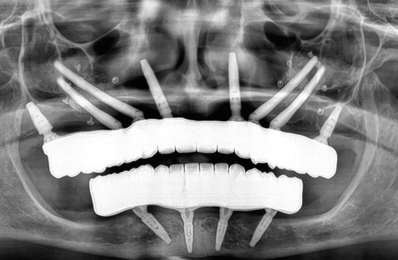 Radiografía panorámica con implantes cigomáticos colocados
